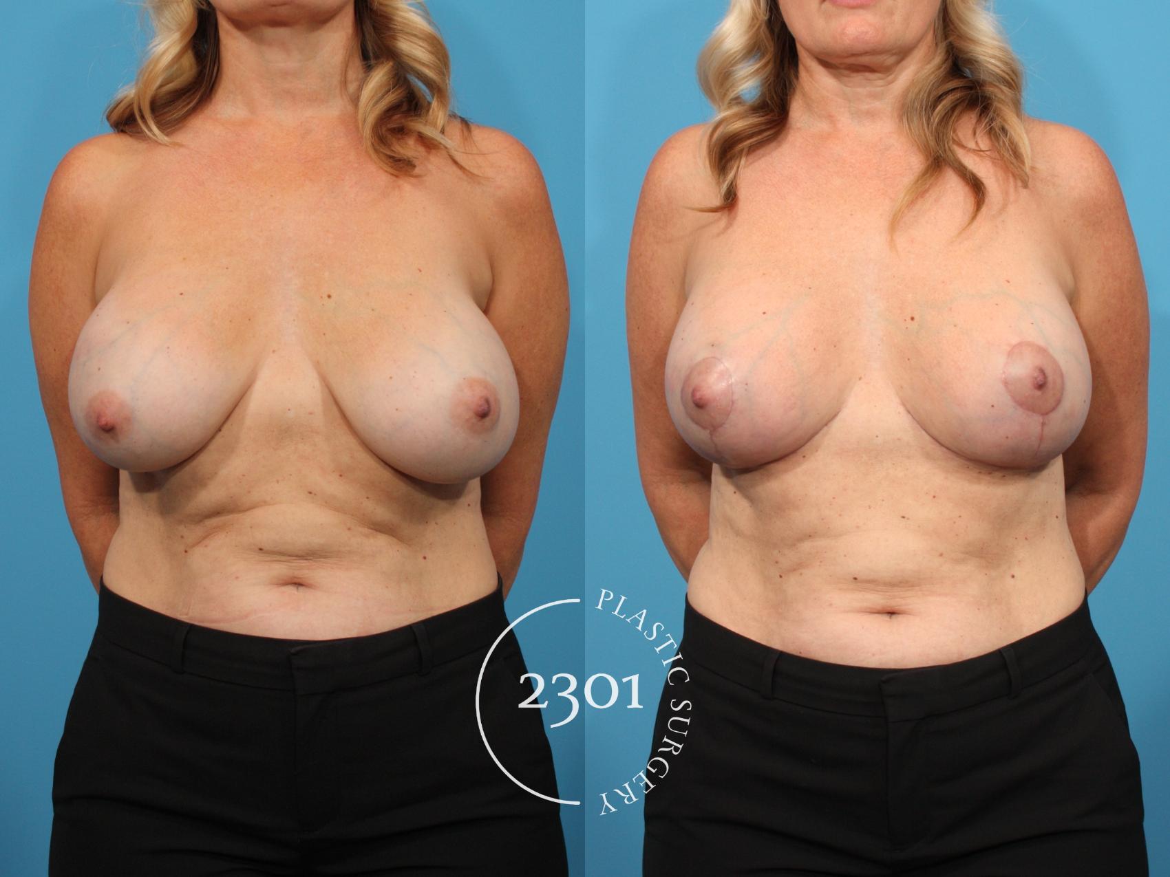Before & After Silicone Implants Case 795 Front View in Fort Worth, Plano, & Frisco, Texas