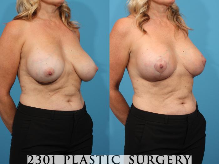 Before & After Mastopexy & Augmentation Case 795 Right Oblique View in Fort Worth, Plano, & Frisco, Texas