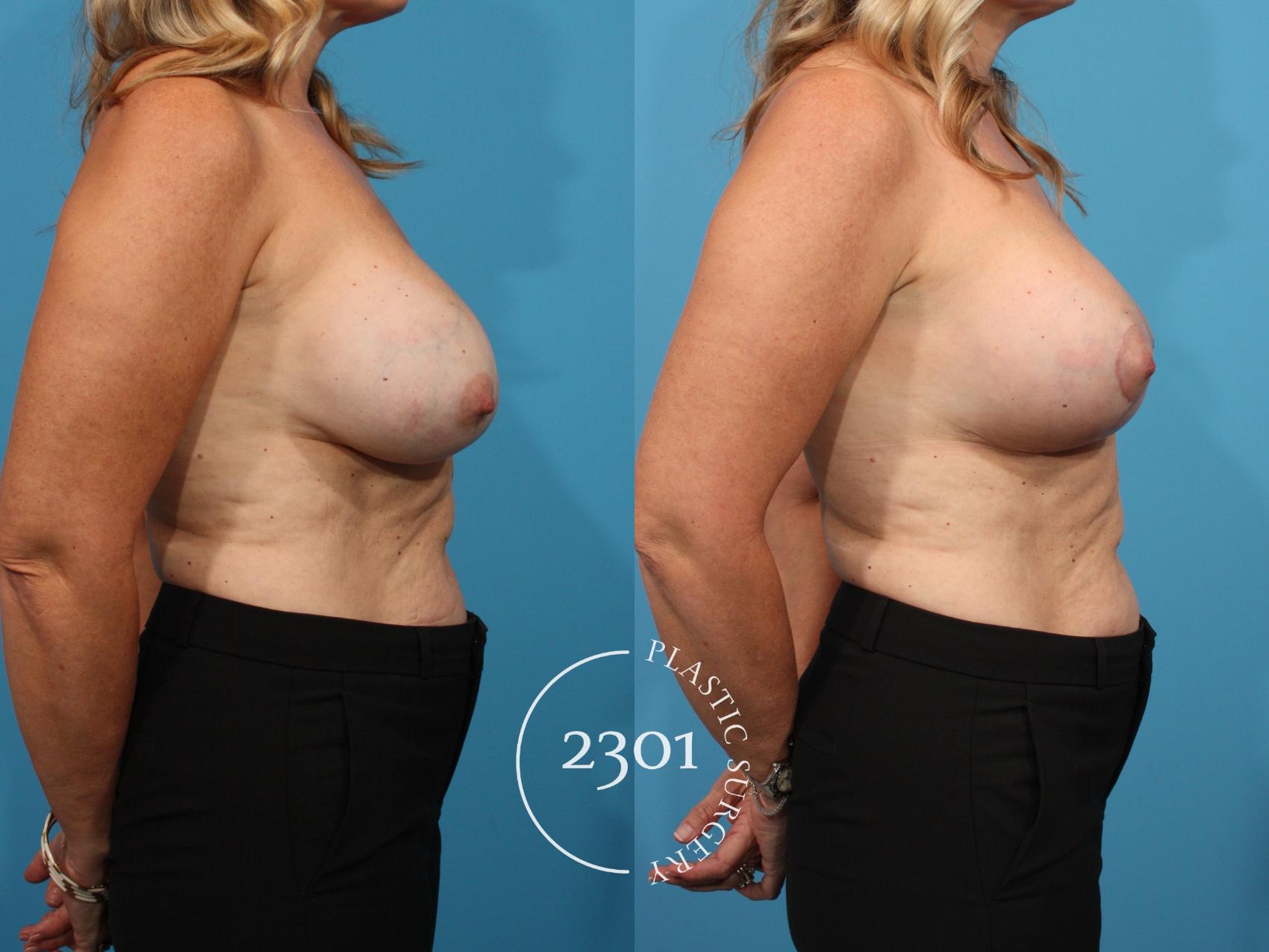 Before & After Silicone Implants Case 795 Right Side View in Fort Worth, Plano, & Frisco, Texas