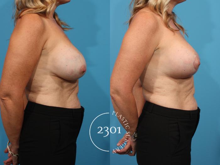 Before & After Mastopexy & Augmentation Case 795 Right Side View in Fort Worth, Plano, & Frisco, Texas