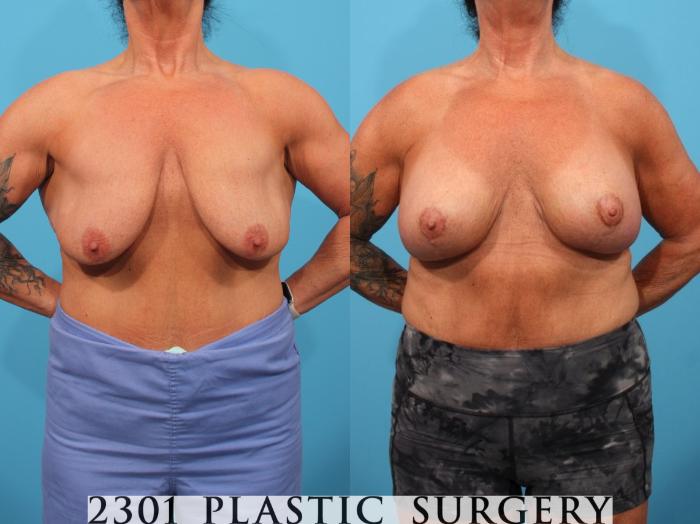 Before & After Silicone Implants Case 796 Front View in Fort Worth, Plano, & Frisco, Texas