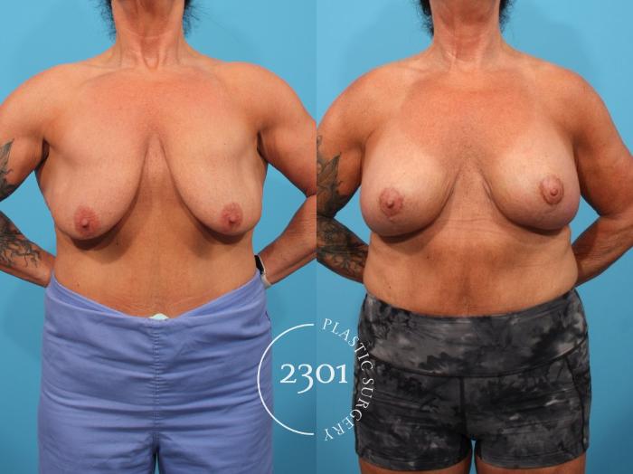 Before & After Silicone Implants Case 796 Front View in Fort Worth, Plano, & Frisco, Texas