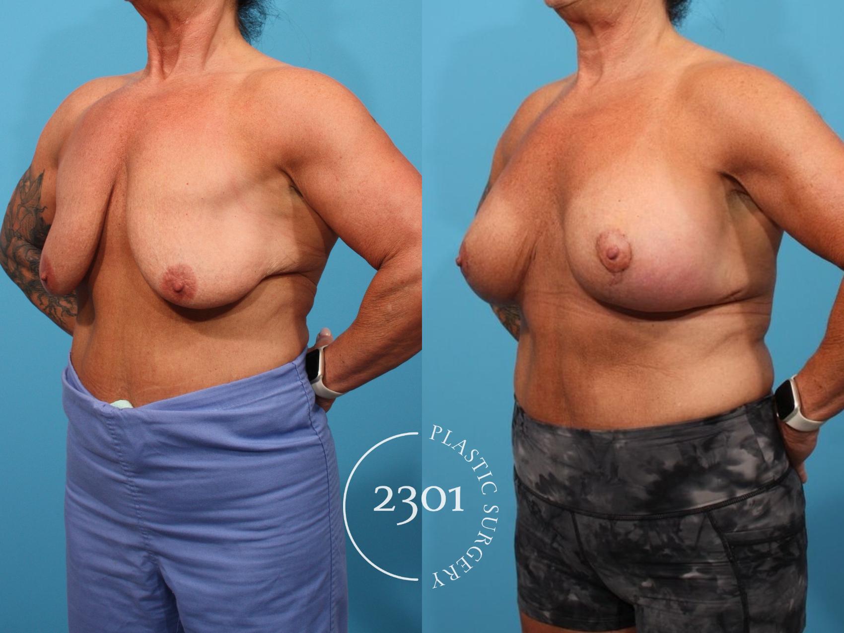 Before & After Mastopexy & Augmentation Case 796 Left Oblique View in Fort Worth, Plano, & Frisco, Texas