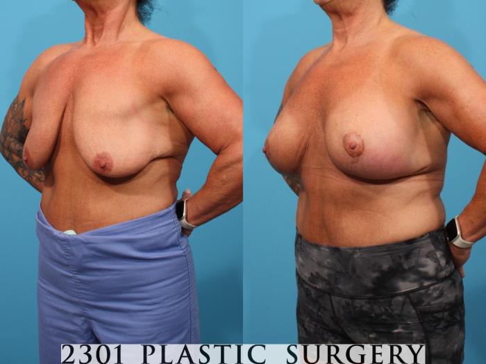 Before & After Silicone Implants Case 796 Left Oblique View in Fort Worth, Plano, & Frisco, Texas