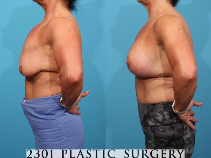 Before & After Silicone Implants Case 796 Left Side View in Fort Worth, Plano, & Frisco, Texas