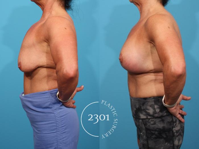 Before & After Mastopexy & Augmentation Case 796 Left Side View in Fort Worth, Plano, & Frisco, Texas