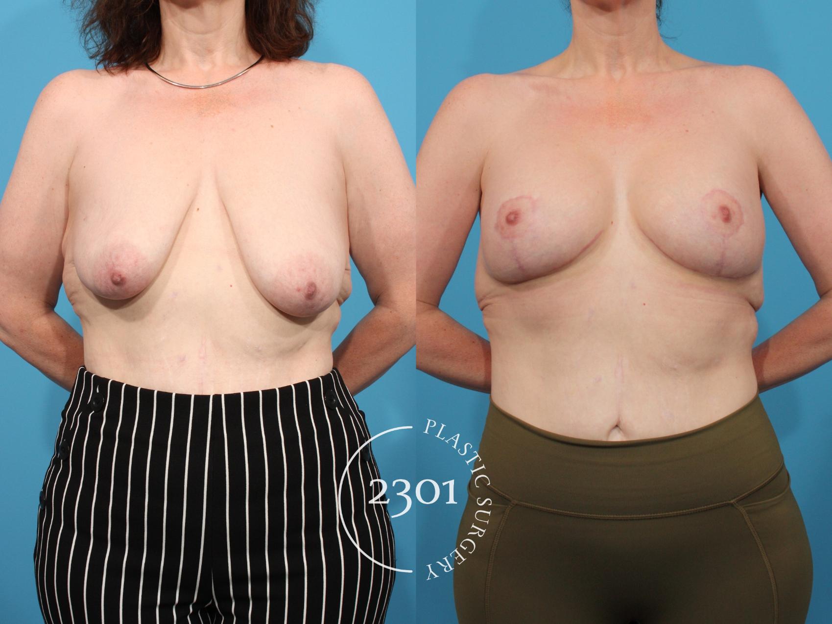 Before & After Breast Lift (Mastopexy) Case 801 Front View in Fort Worth, Plano, & Frisco, Texas