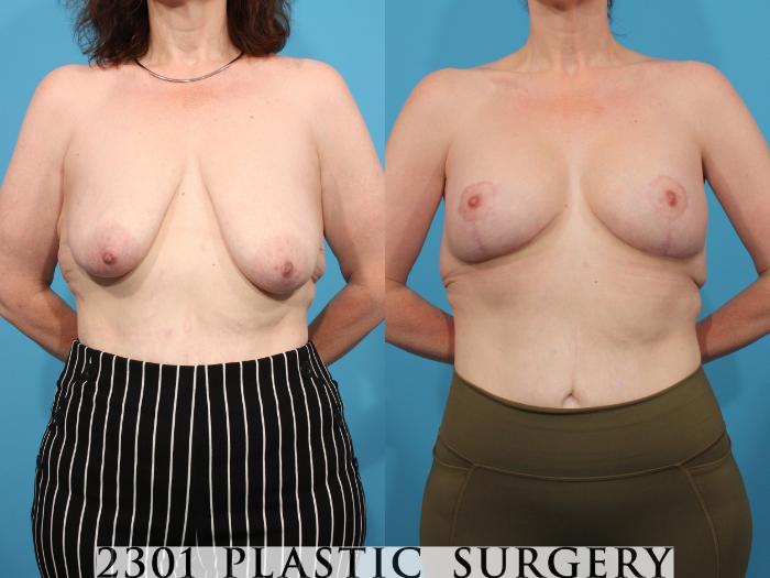 Before & After Silicone Implants Case 801 Front View in Fort Worth, Plano, & Frisco, Texas