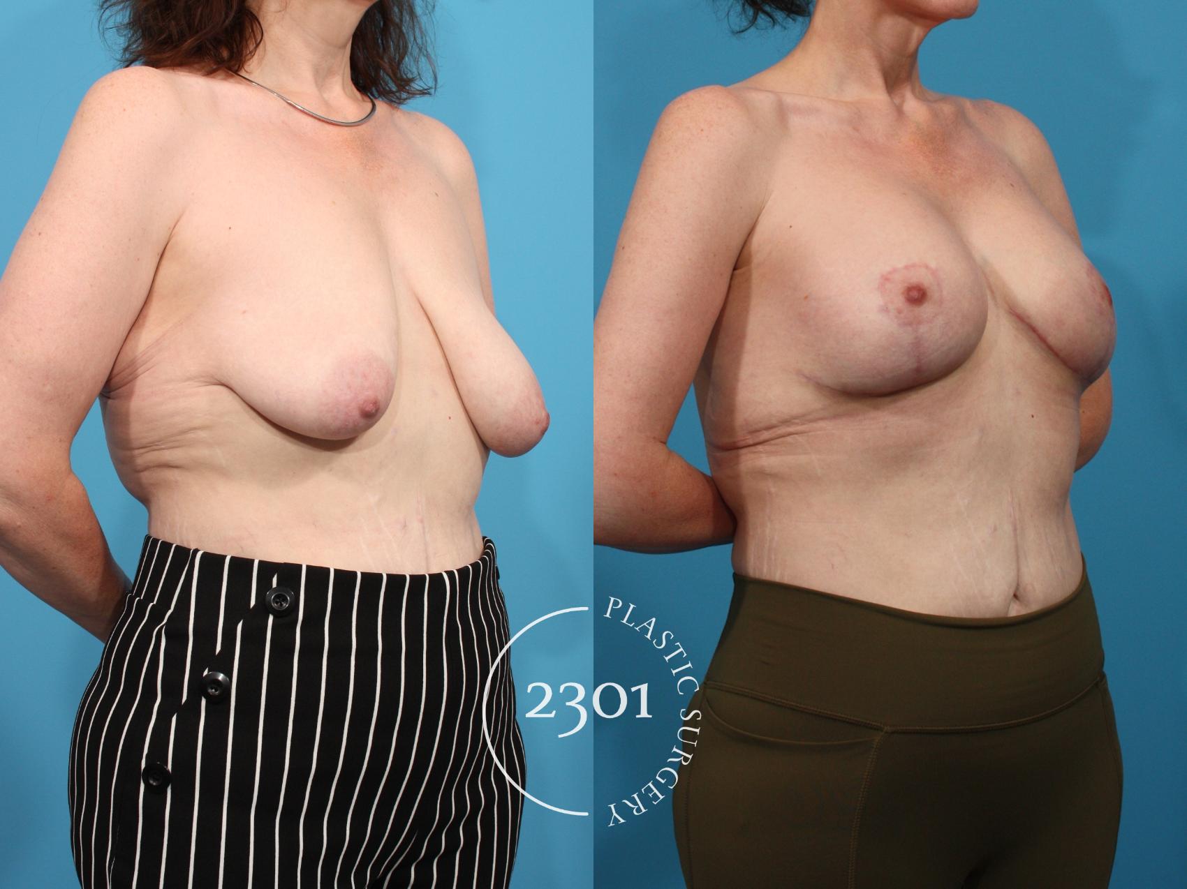 Before & After Mastopexy & Augmentation Case 801 Right Oblique View in Fort Worth, Plano, & Frisco, Texas