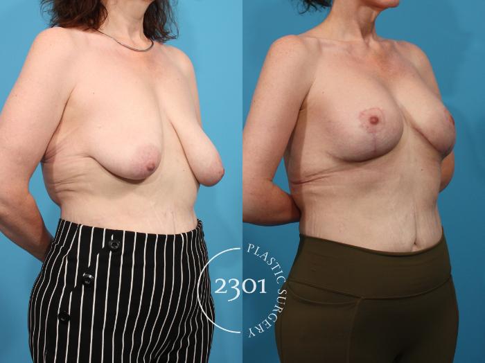 Before & After Breast Lift (Mastopexy) Case 801 Right Oblique View in Fort Worth, Plano, & Frisco, Texas