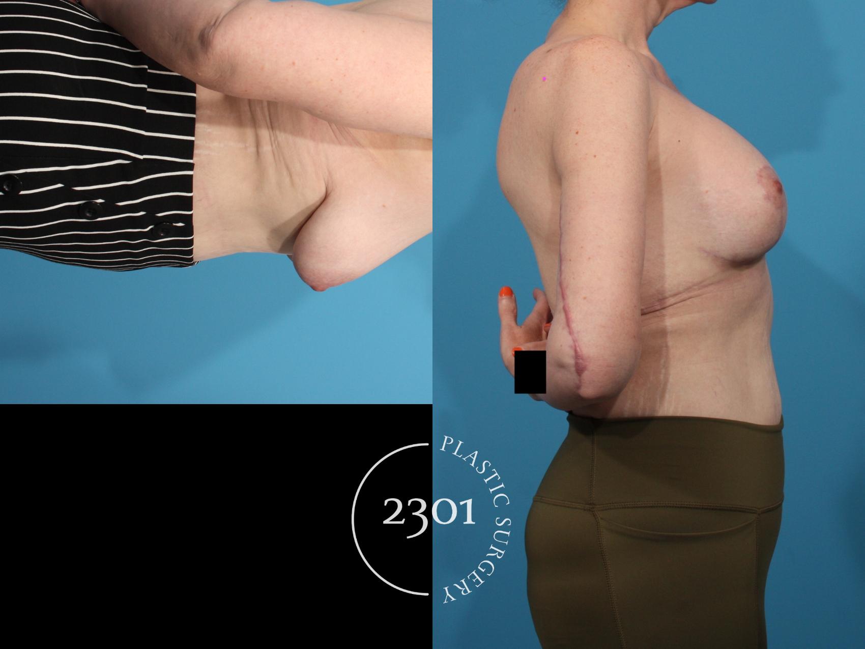 Before & After Mastopexy & Augmentation Case 801 Right Side View in Fort Worth, Plano, & Frisco, Texas