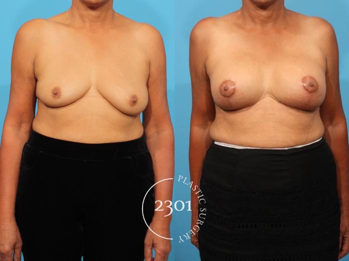 Before & After Breast Lift (Mastopexy) Case 811 Front View in Fort Worth, Plano, & Frisco, Texas