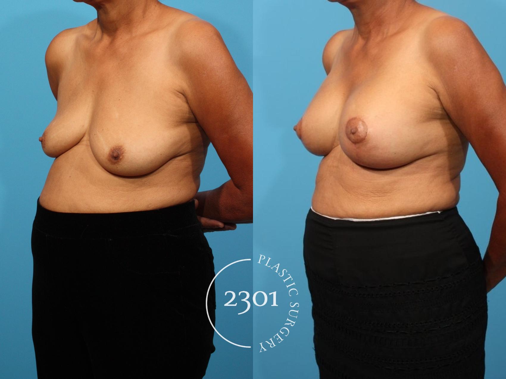 Before & After Mastopexy & Augmentation Case 811 Left Oblique View in Fort Worth, Plano, & Frisco, Texas