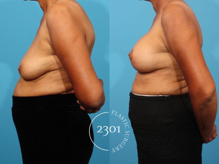 Before & After Breast Lift (Mastopexy) Case 811 Left Side View in Fort Worth, Plano, & Frisco, Texas