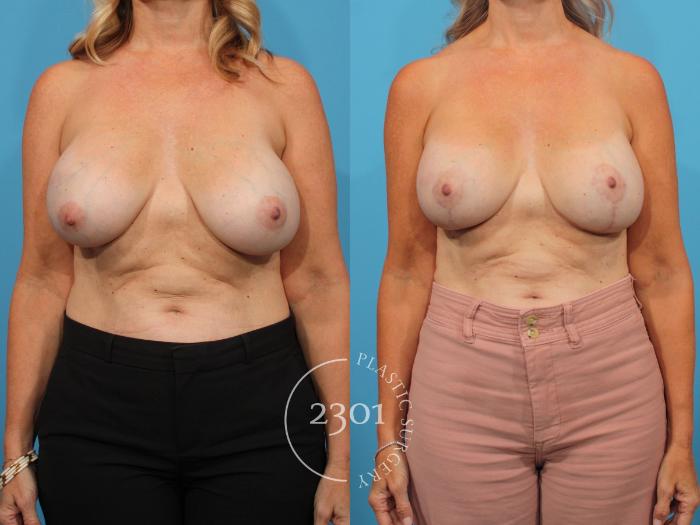 Before & After Breast Lift (Mastopexy) Case 836 Front View in Fort Worth, Plano, & Frisco, Texas