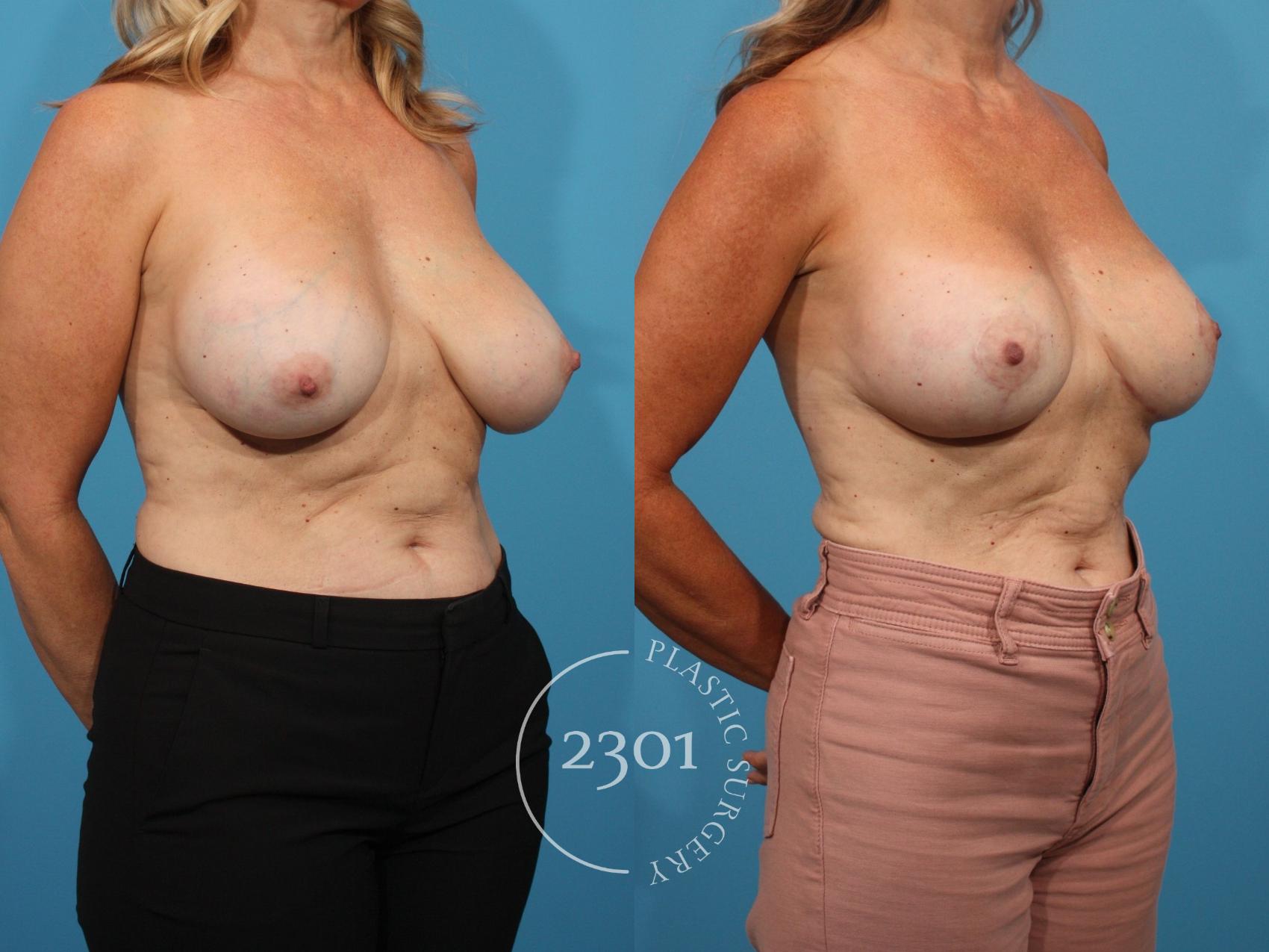 Before & After Silicone Implants Case 836 Right Oblique View in Fort Worth, Plano, & Frisco, Texas