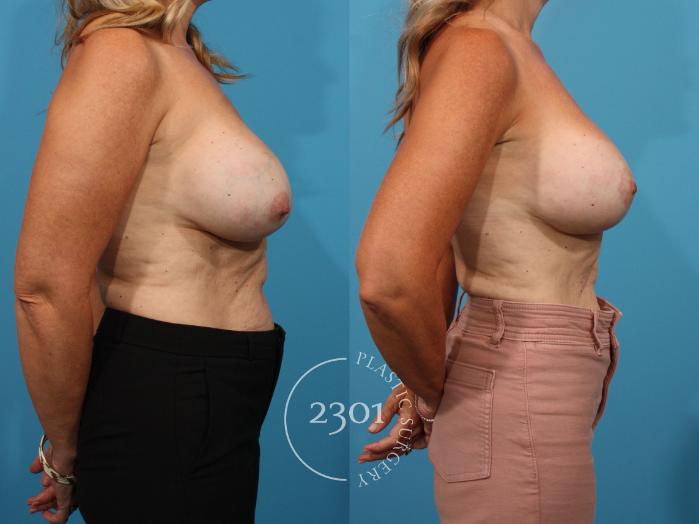 Before & After Breast Lift (Mastopexy) Case 836 Right Side View in Fort Worth, Plano, & Frisco, Texas