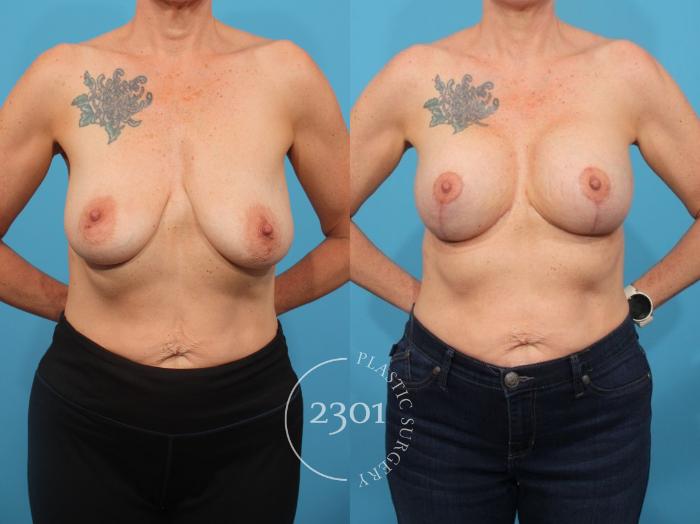 Before & After Mastopexy & Augmentation Case 855 Front View in Fort Worth, Plano, & Frisco, Texas