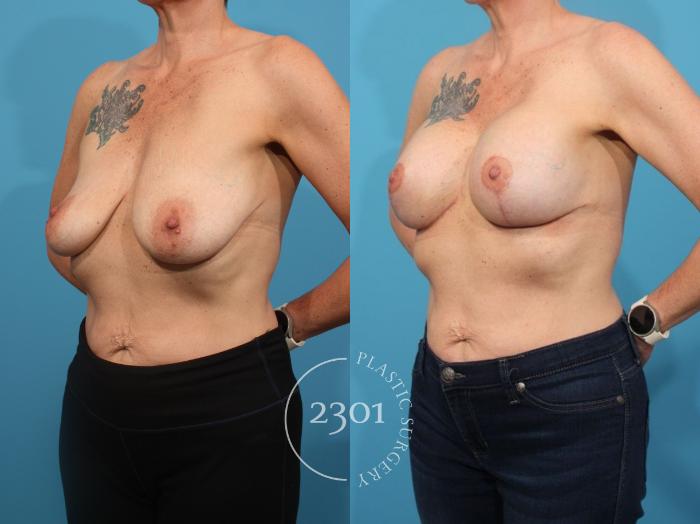 Before & After Mastopexy & Augmentation Case 855 Left Oblique View in Fort Worth, Plano, & Frisco, Texas