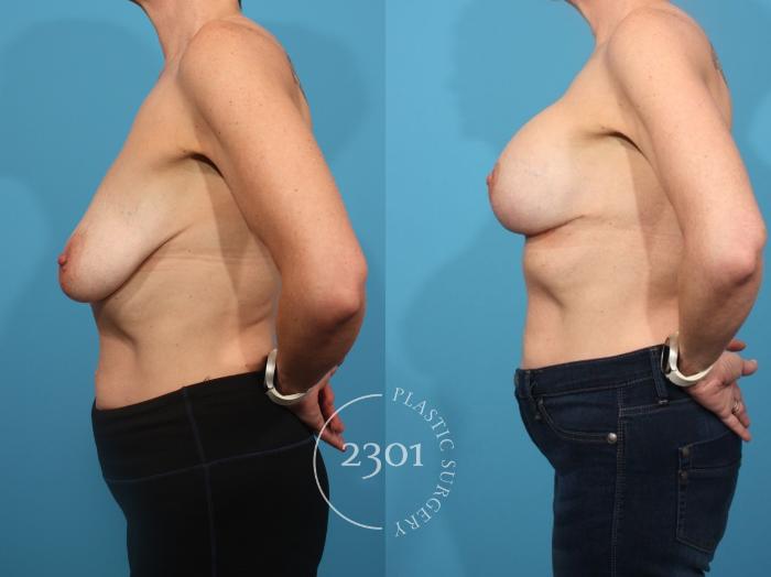 Before & After Mastopexy & Augmentation Case 855 Left Side View in Fort Worth, Plano, & Frisco, Texas