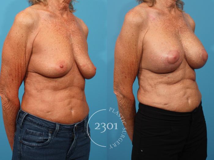 Before & After Mastopexy & Augmentation Case 870 Right Oblique View in Fort Worth, Plano, & Frisco, Texas