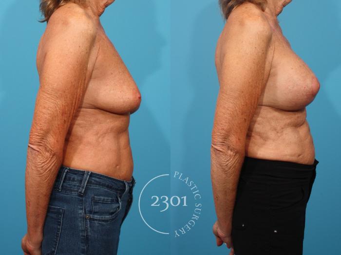 Before & After Mastopexy & Augmentation Case 870 Right Side View in Fort Worth, Plano, & Frisco, Texas