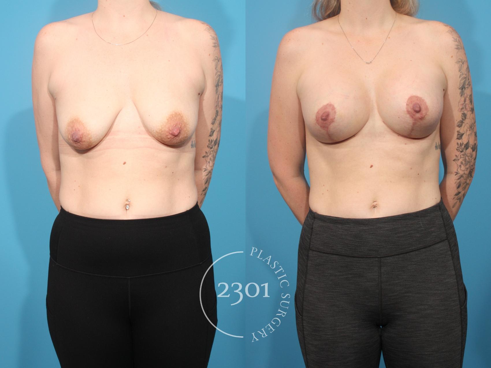 Before & After Breast Lift (Mastopexy) Case 879 Front View in Fort Worth, Plano, & Frisco, Texas
