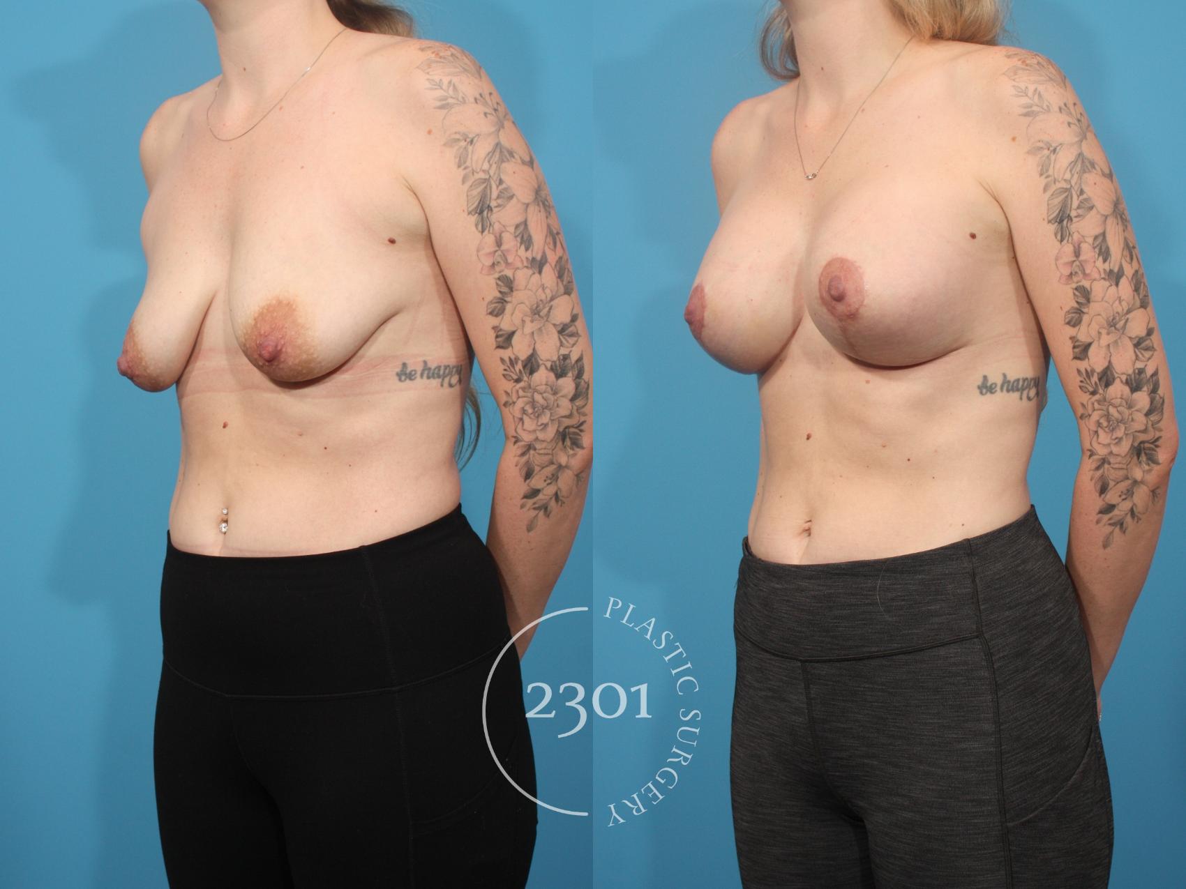 Before & After Mastopexy & Augmentation Case 879 Left Oblique View in Fort Worth, Plano, & Frisco, Texas