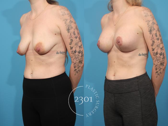 Before & After Mastopexy & Augmentation Case 879 Left Oblique View in Fort Worth, Plano, & Frisco, Texas