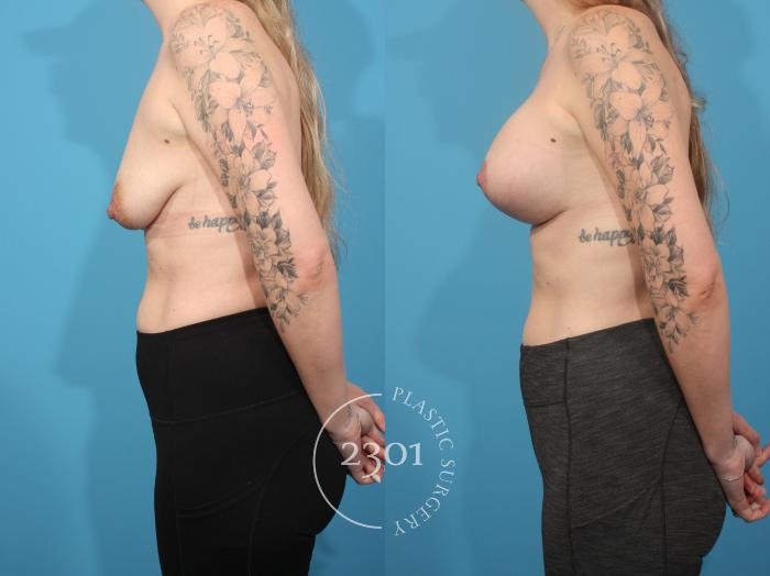 Before & After Mastopexy & Augmentation Case 879 Left Side View in Fort Worth, Plano, & Frisco, Texas