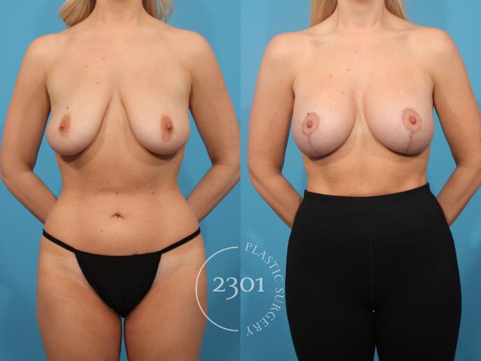 Before & After Mastopexy & Augmentation Case 884 Front View in Fort Worth, Plano, & Frisco, Texas