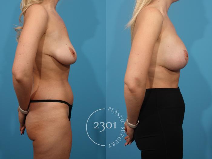 Before & After Mastopexy & Augmentation Case 884 Right Side View in Fort Worth, Plano, & Frisco, Texas