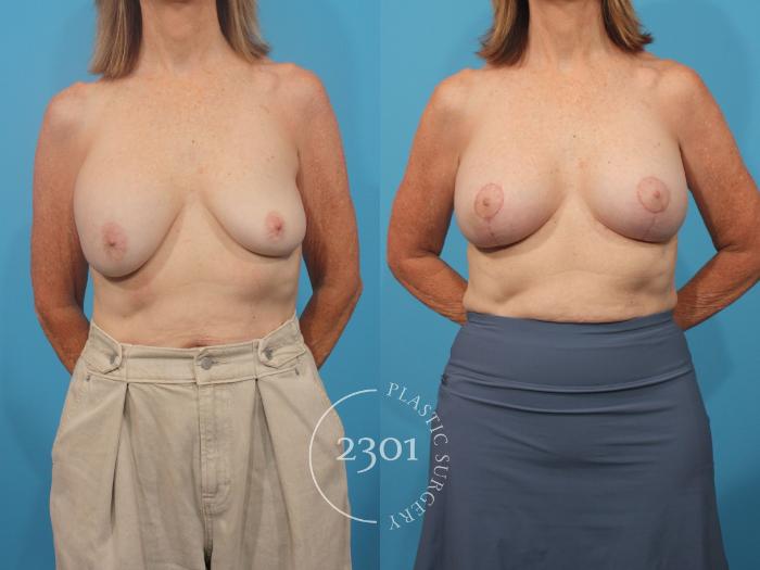 Before & After Mastopexy & Augmentation Case 889 Front View in Fort Worth, Plano, & Frisco, Texas