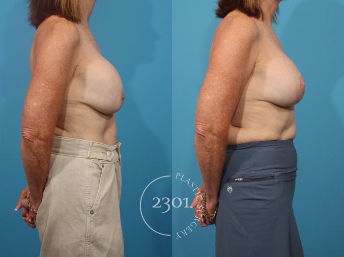 Before & After Mastopexy & Augmentation Case 889 Right Side View in Fort Worth, Plano, & Frisco, Texas