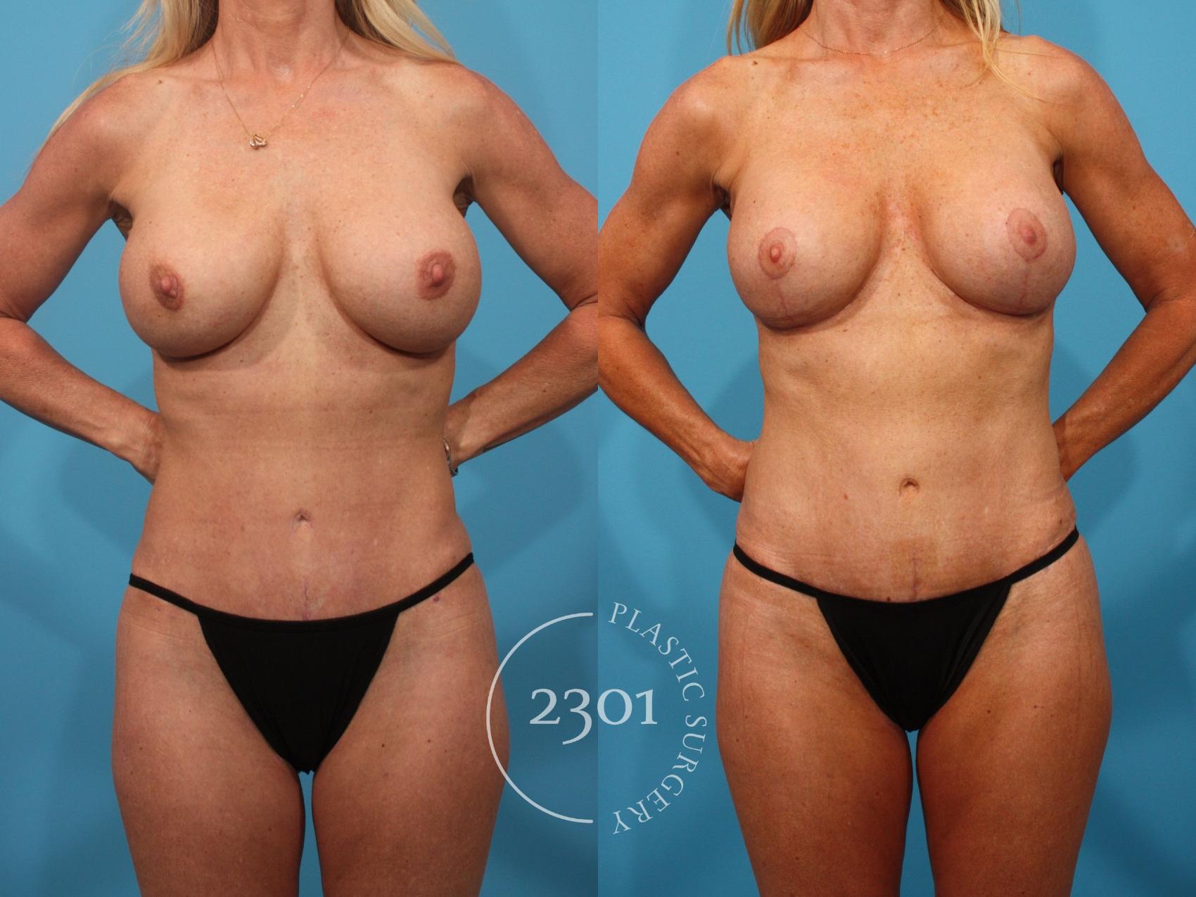 Before & After Mastopexy & Augmentation Case 890 Front View in Fort Worth, Plano, & Frisco, Texas