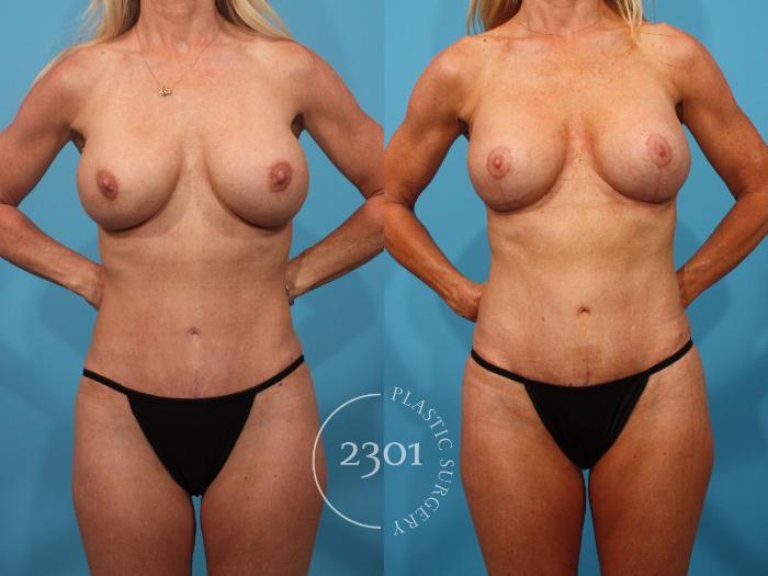 Before & After Mastopexy & Augmentation Case 890 Front View in Fort Worth, Plano, & Frisco, Texas