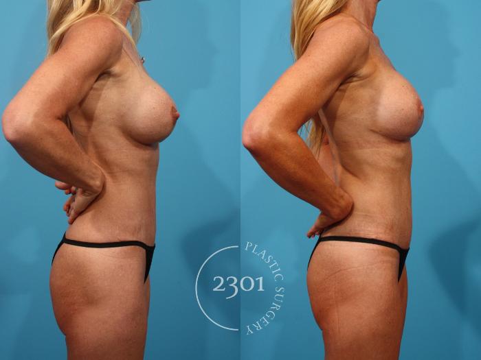 Before & After Mastopexy & Augmentation Case 890 Right Side View in Fort Worth, Plano, & Frisco, Texas