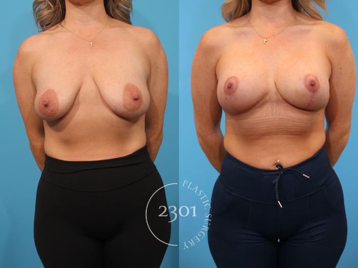 Before & After Mastopexy & Augmentation Case 901 Front View in Fort Worth, Plano, & Frisco, Texas