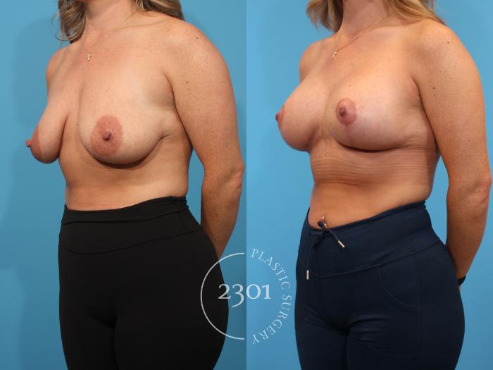 Before & After Mastopexy & Augmentation Case 901 Left Oblique View in Fort Worth, Plano, & Frisco, Texas