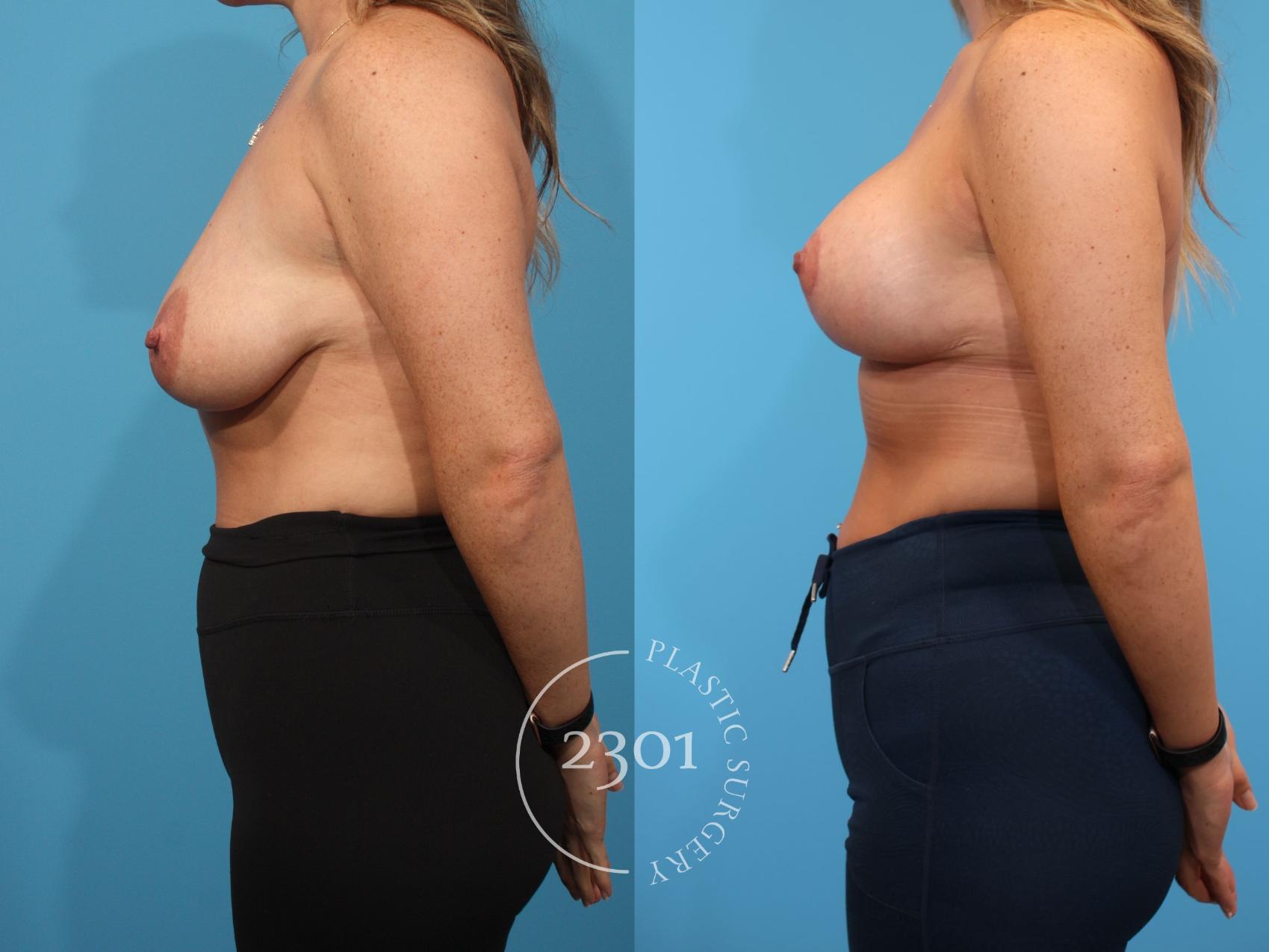 Before & After Mastopexy & Augmentation Case 901 Left Side View in Fort Worth, Plano, & Frisco, Texas