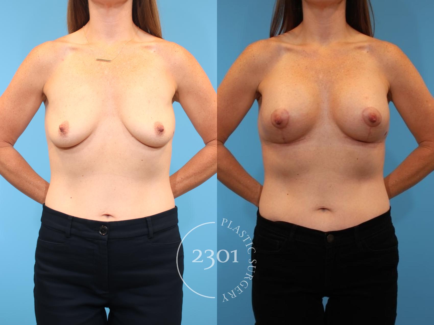 Before & After Mastopexy & Augmentation Case 917 Front View in Fort Worth, Plano, & Frisco, Texas