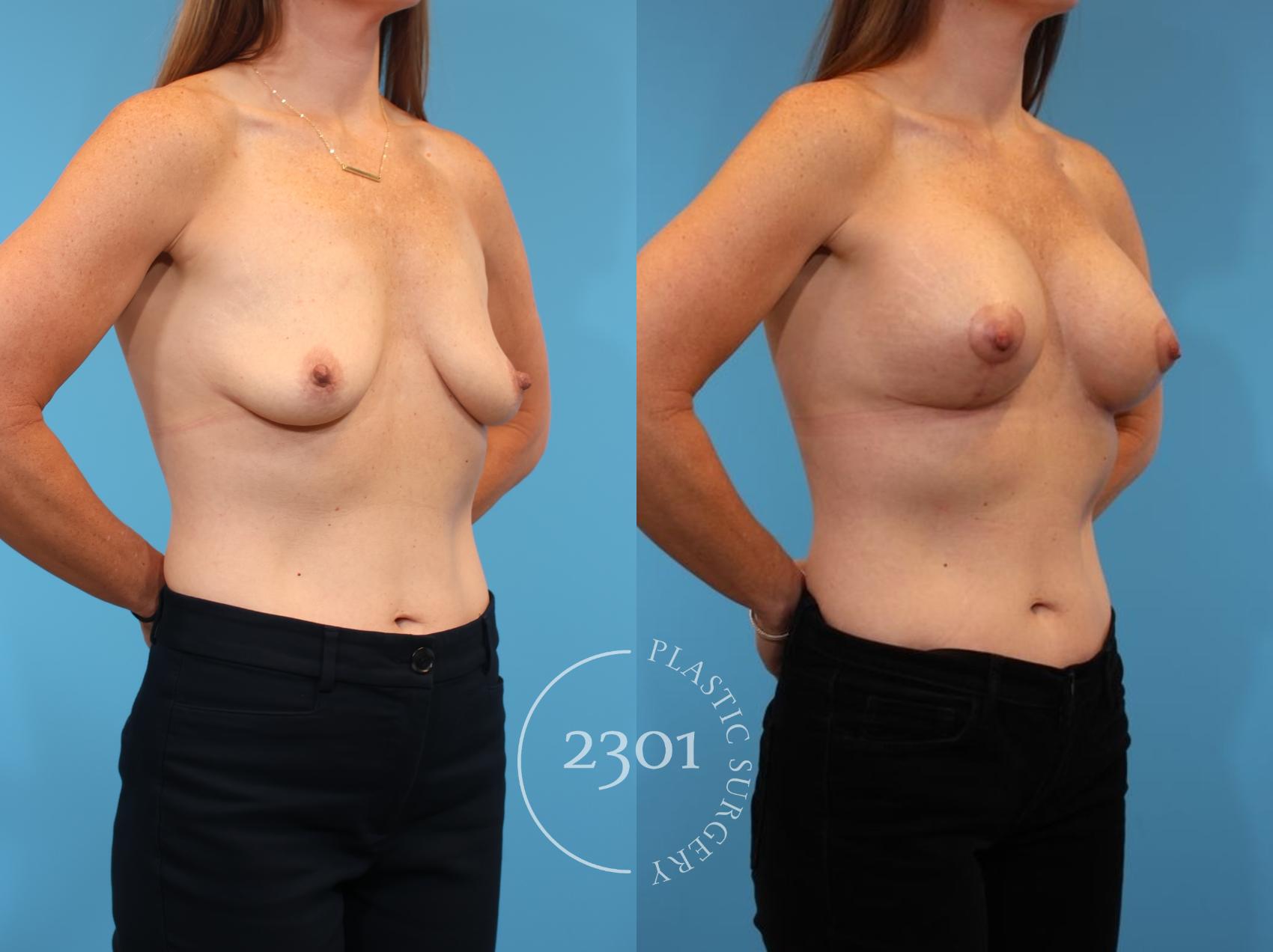 Before & After Mastopexy & Augmentation Case 917 Right Oblique View in Fort Worth, Plano, & Frisco, Texas