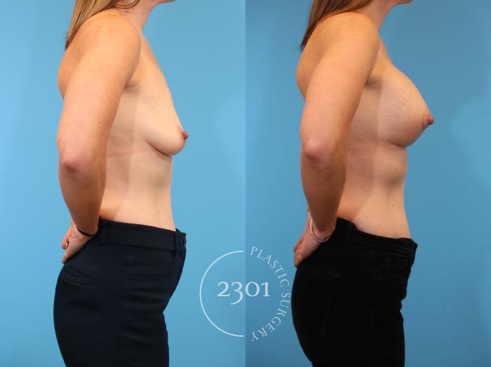 Before & After Mastopexy & Augmentation Case 917 Right Side View in Fort Worth, Plano, & Frisco, Texas