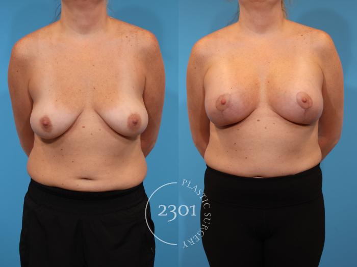 Before & After Silicone Implants Case 923 Front View in Fort Worth, Plano, & Frisco, Texas