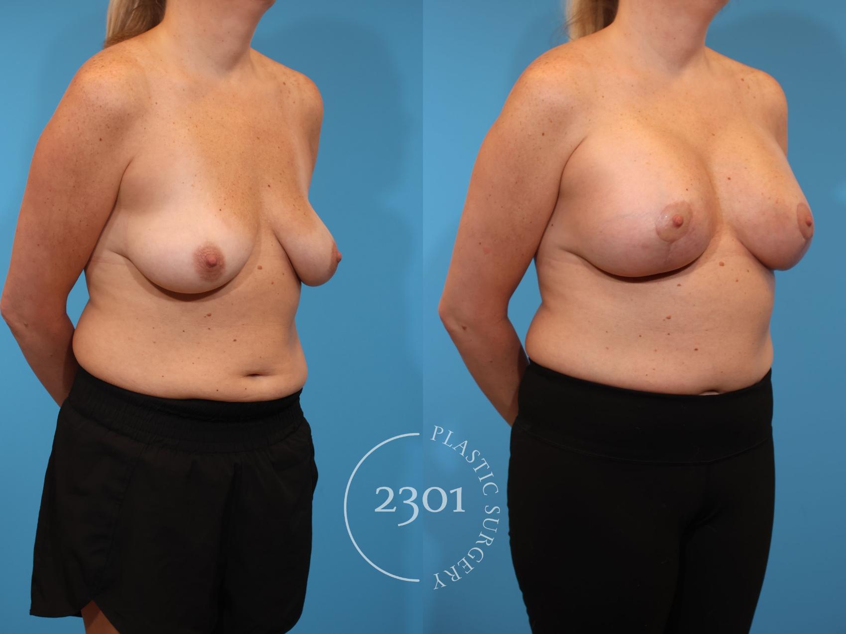 Before & After Silicone Implants Case 923 Right Oblique View in Fort Worth, Plano, & Frisco, Texas