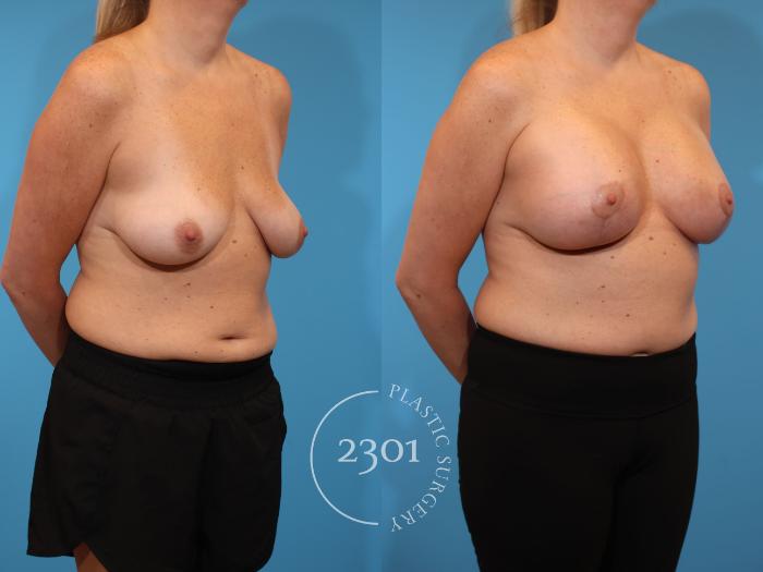 Before & After Silicone Implants Case 923 Right Oblique View in Fort Worth, Plano, & Frisco, Texas