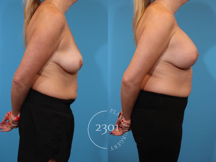 Before & After Silicone Implants Case 923 Right Side View in Fort Worth, Plano, & Frisco, Texas