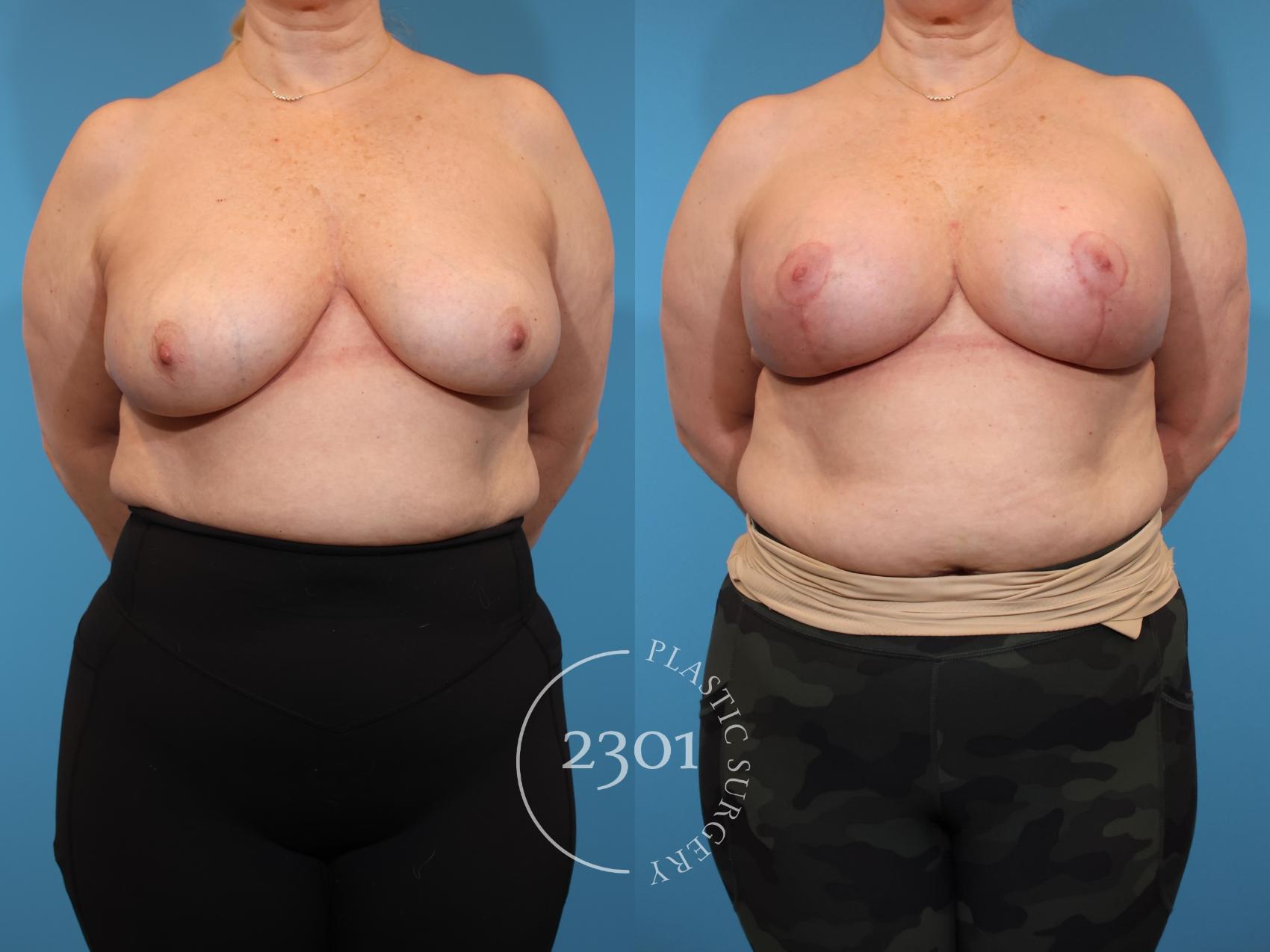 Before & After Mastopexy & Augmentation Case 934 Front View in Fort Worth, Plano, & Frisco, Texas