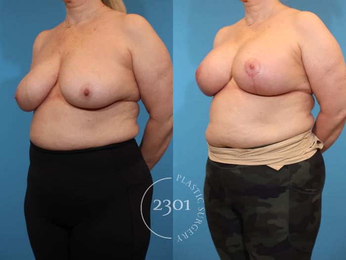 Before & After Mastopexy & Augmentation Case 934 Left Oblique View in Fort Worth, Plano, & Frisco, Texas