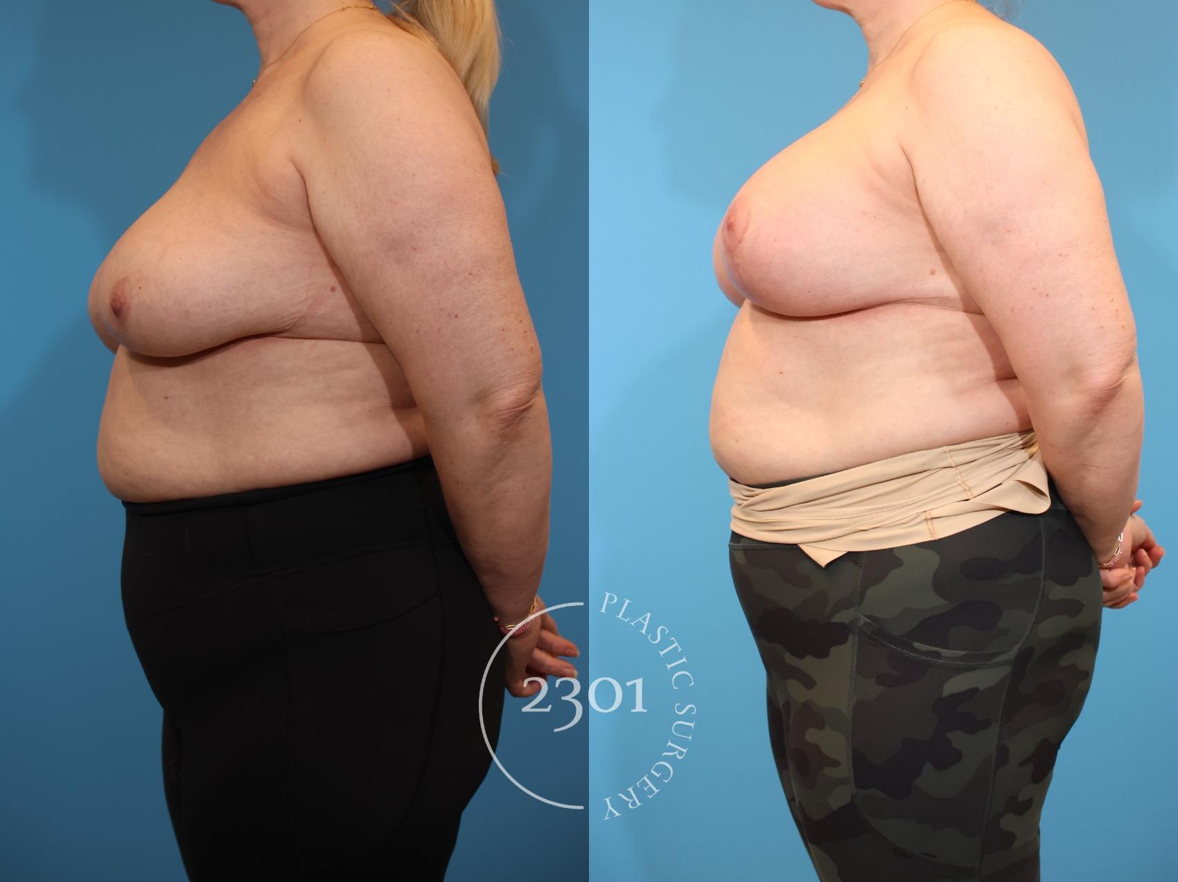 Before & After Mastopexy & Augmentation Case 934 Left Side View in Fort Worth, Plano, & Frisco, Texas
